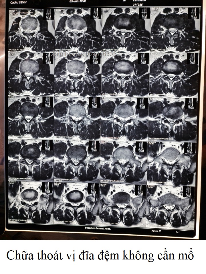 Chữa thoát vị đĩa đệm không cần mổ